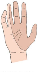 Medianusnerven går ud til tommelfinger, pegefinger, langefinger og en del af ringefingeren. Her vil man opleve symptomerne på karpaltunnelsyndrom