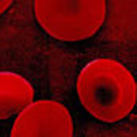 Sundhedsguiden.dk - Blodmangel. Inhold hæmoglobin, røde blodlegmer, Anæmi, hæmolytisk anæmi, seglcelleanæmi, thalassæmi, cooleys anæm