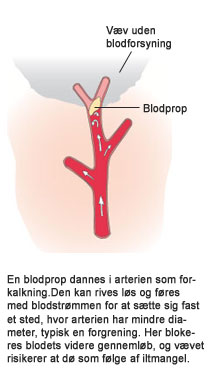 Íllustration af arterie med forgreninger. En blodprop kan rive sig løs og sætte sig fast et andet sted i arterien (emboli), hvor den er smallere. Blodets videre gennemløb kan blive blokeret.