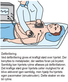Illustration af en læge, der defibrillerer en mand. Der gives stød gennem to metalplader på brystet, som giver mulighed for, at hjertet går i gang igen.