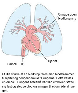 Illustration af lunge, hjerte og en embolis vandring gennem hjertet og ud til lungernes mindre årer.