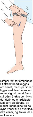 Billede af ben og åreknude. Simpel test for åreknuder. Et stramt bånd lægges om benet, mens personen ligger ned. Når personen rejser sig, vil benet fremstå uden åreknuder. Hvis der derimod er ødelagte klapper i blodårene, vil blodet kunne løbe fra de dybe vener til de overfladiske vener, og åreknuderne kan ses.
