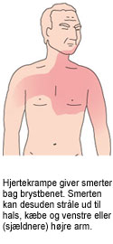 Billede af mand med markering af symptomudbredelse af blodprop i hjertet. Hjertekramper giver smerter bag brystbenet. Smerten kan desuden stråle ud til hals, kæbe og venstre eller (sjældnere) højre arm.