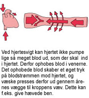 Billede af hhv. hjerte og vene med ophobet blod, hvor blodet bliver presset ud gennem årevæggen. Det kan f.eks. give hævede ben.
