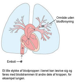 Illustration af lunge og hjerte. En blodprop i benet kan løsrive sig til en emboli og sætte sig i f.eks. en åre i lungen.