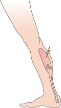 Billede af lægmusklen. Kramper kan afhjælpes ved udstrækning eller massage