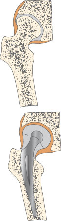 Et led kan udskiftes helt med med et kunstigt led i enten metal eller gummi