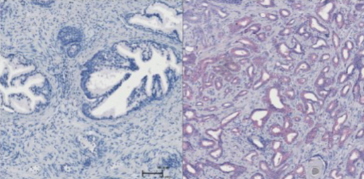 Venstre billeder viser SRPK1 molekylet i sundt prostata væv og til højre i kræftramt væv.