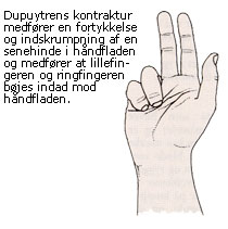 Billede af hånd Dupuytrens kontraktur. Dupuytrens kontraktur medfører en fortykkelse og indskrumpning af en senehinde i håndfladen og medfører, at lillefingeren og ringfingeren bøjes indad mod håndfladen.